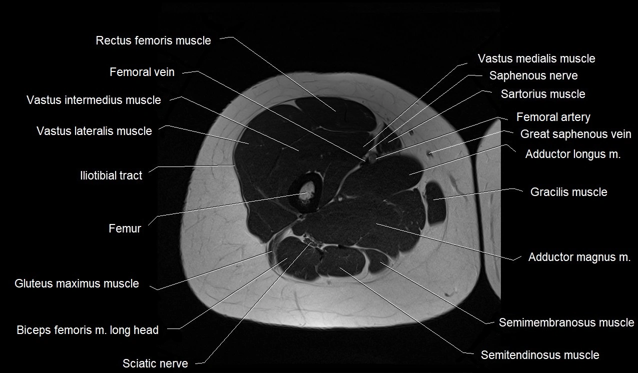 MRI thigh cross sectional anatomy image 25.webp